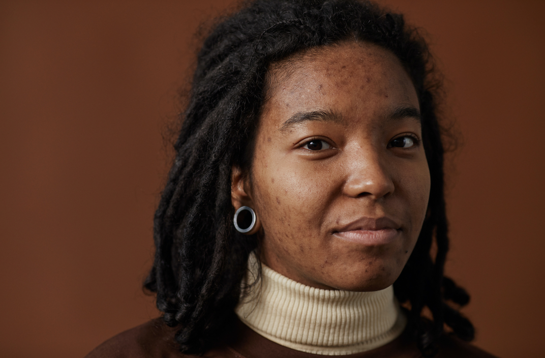 Tout savoir sur l’acné hormonale